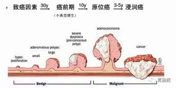 體檢查出腸息肉一定要切除！ 95%腸癌由它演變而來