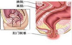 南寧治療脫肛哪家醫(yī)院好？南寧脫肛治療多少錢(qián)？